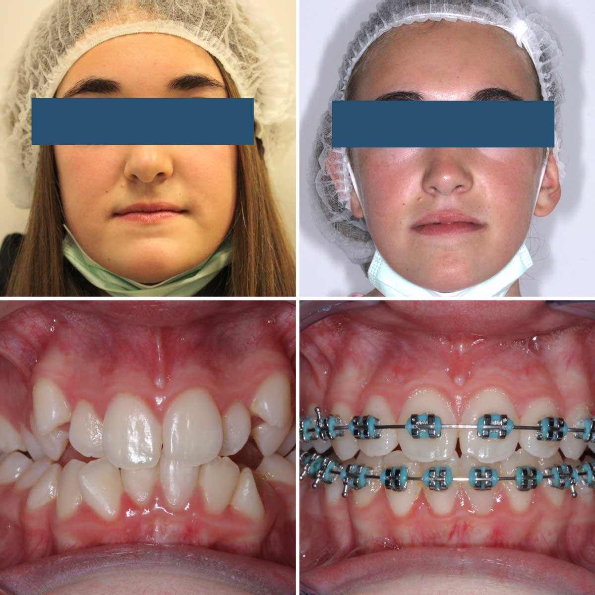 Before and after MARPE treatment and fixed conventional braces. Malocclusion Class III. German-speaking Orthodontist Dr. Heinz-Oliver Siebelist, expert at correcting crowded teeth and a narrow maxilla.