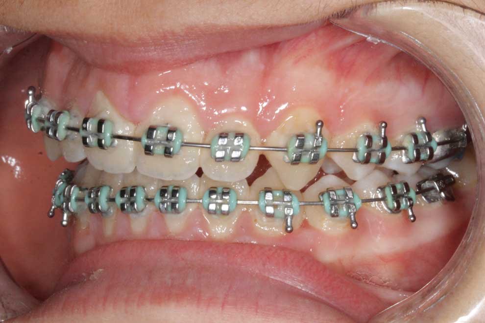 The end of an Orthodontic treatment, traditional (metal) braces for teeth correction. German-speaking Orthodontist Dr. Heinz-Oliver Siebelist in Algarve and Lisbon, Portugal.