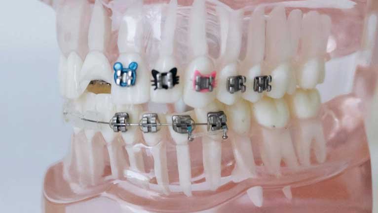 Orthodontic services, conventional braces for teeth correction. Orthodontist Dr. Heinz-Oliver Siebelist in Portugal, speacialist in braces & aligners. Traditional metal brackets expert.