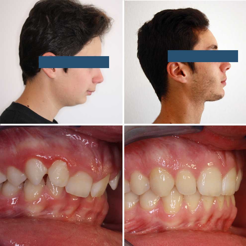 Before and after a Malocclusion class II (overbite) correction by German-speaking Orthodontist Dr. Siebelist. Expert in Malocclusion Class II & Class III treatment and prevention. Lisbon and Algarve region in Portugal.