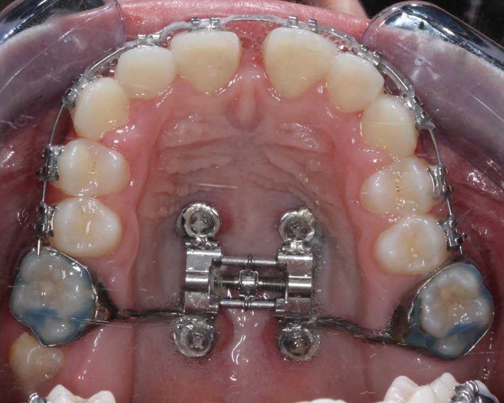 Imagem posterior de mordida desalinhada e maxilar estreito com dentes apinhados, má oclusão de Classe III. Solução ortodôntica: MARPE e aparelho tradicional. Endireitamento dos dentes com o ortodontista alemão Dr. Siebelist em Portugal.