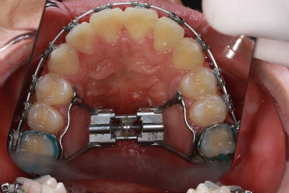 Hyrax treatment – Early Intervention for a Narrow Maxilla. The Hyrax expander is a non-invasive orthodontic solution for children, expanding the upper jaw.