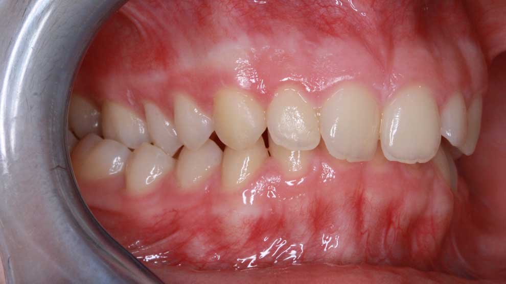 Crossbite. Treatment and correction of an crossbite. Orthodontic solutions by Orthodontist Dr. Heinz in Portugal.